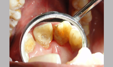 Cosmetic dentistry treatment in Anand
                        